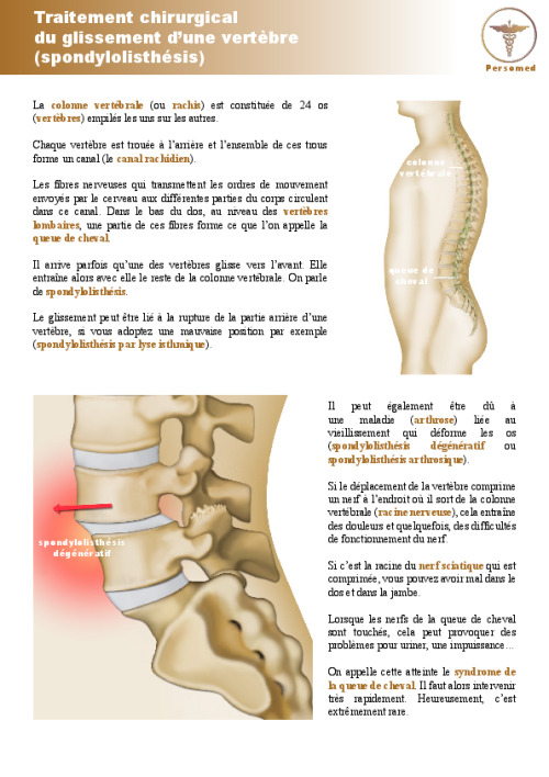 Traitement chirurgical du glissement d’une vertèbre (spondylolisthésis)
