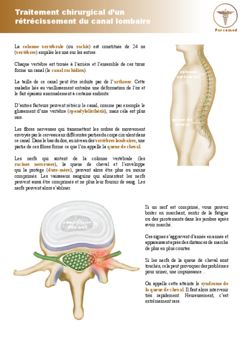 Traitement chirurgical d’un rétrécissement du canal lombaire
