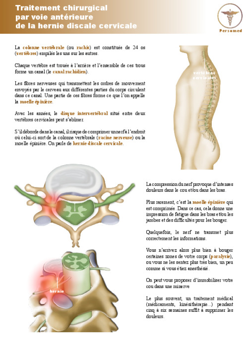 Traitement chirurgical par voie antérieure de la hernie discale cervicale