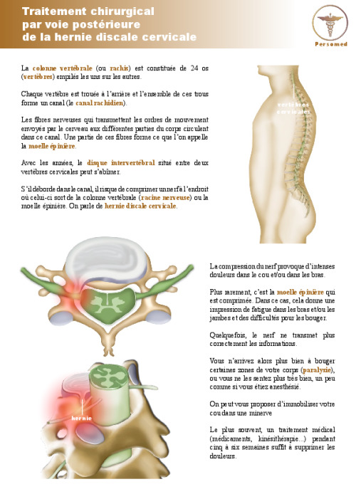 Traitement chirurgical par voie postérieure de la hernie discale cervicale