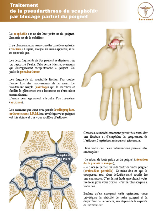 Traitement de la pseudarthrose du scaphoïde par blocage partiel du poignet