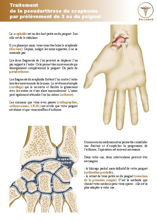 Traitement de la pseudarthrose du scaphoïde par prélèvement de 3 os du poignet