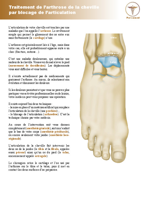 Traitement de l’arthrose de la cheville par blocage de l’articulation