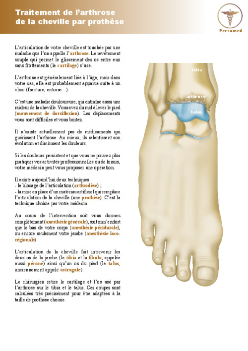 Traitement de l’arthrose de la cheville par prothèse