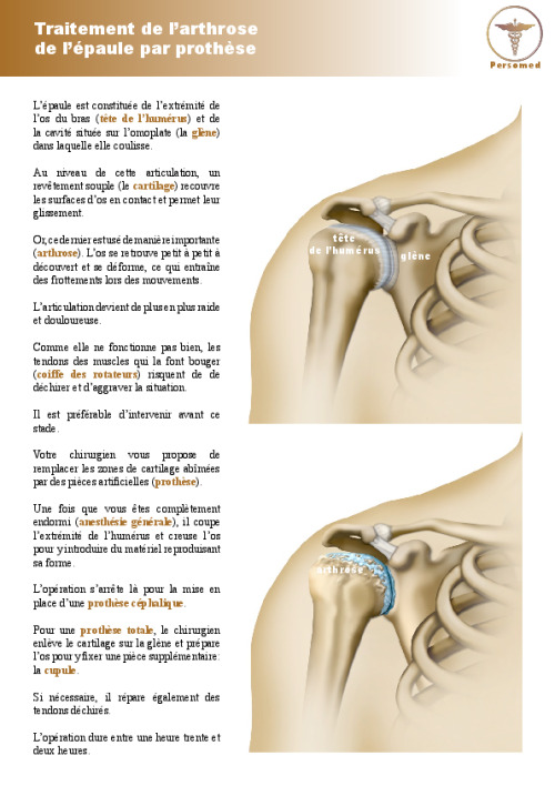 Traitement de l’arthrose de l’épaule par prothèse