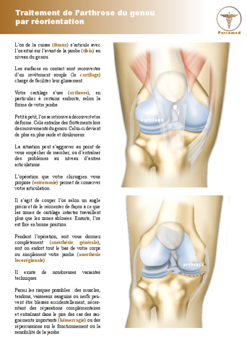 Traitement de l’arthrose du genou par réorientation