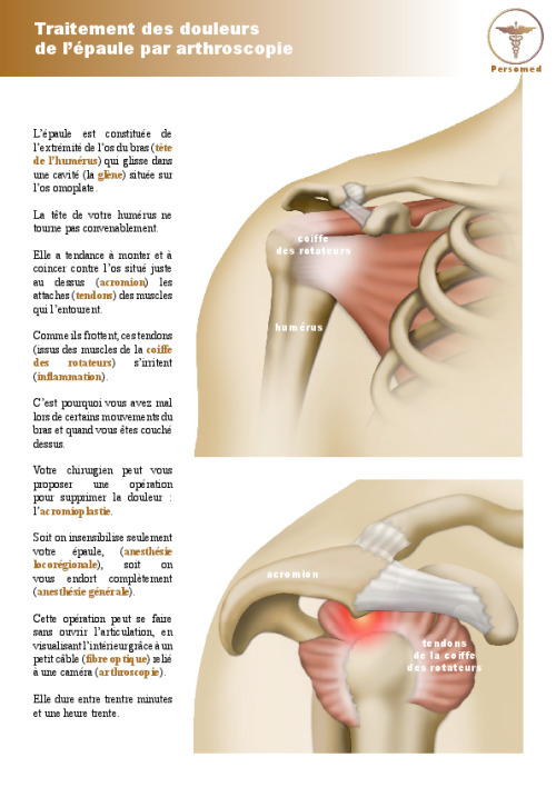 Traitement des douleurs de l’épaule par arthroscopie