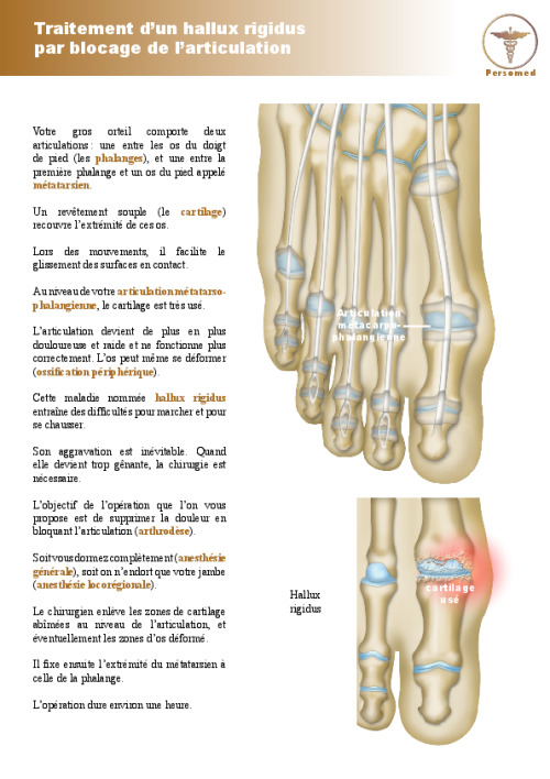 Traitement d’un hallux rigidus par blocage de l’articulation