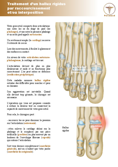 Traitement d’un hallux rigidus par raccourcissement et/ou interposition