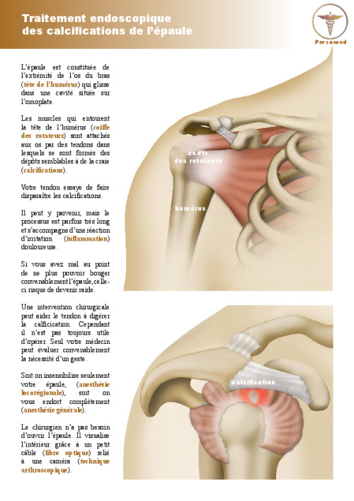 Traitement endoscopique des calcifications de l’épaule
