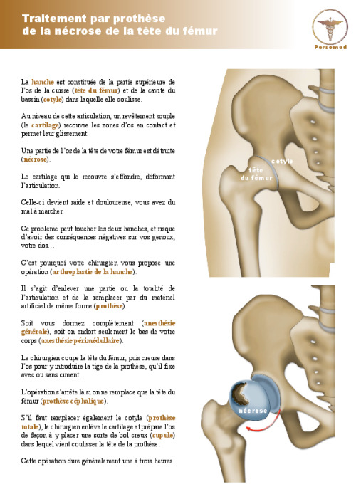 Traitement par prothèse de la nécrose de la tête du fémur