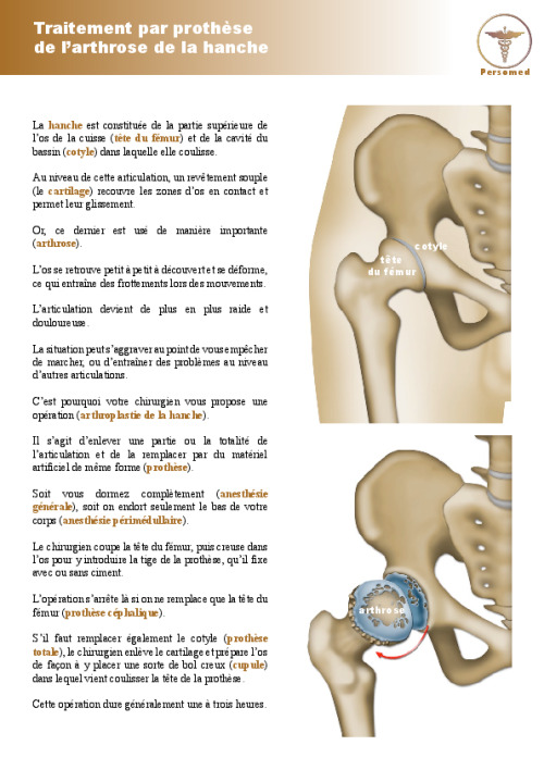 Traitement par prothèse de l’arthrose de la hanche