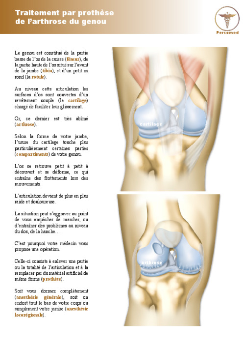 Traitement par prothèse de l’arthrose du genou