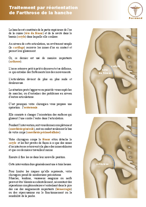 Traitement par réorientation de l’arthrose de la hanche