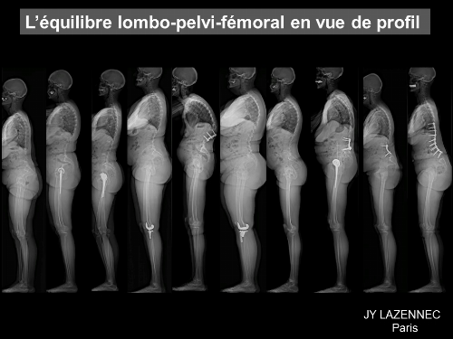 L’équilibre sagittal lombo-pelvi-fémoral