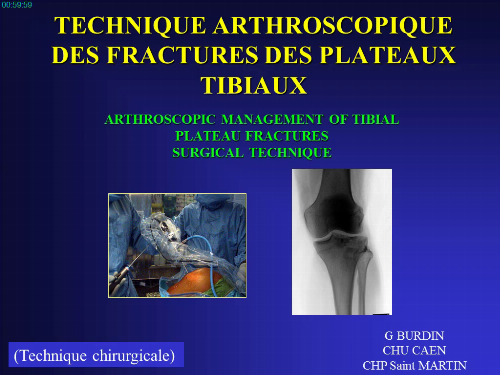 Technique arthroscopique des fractures des plateaux tibiaux