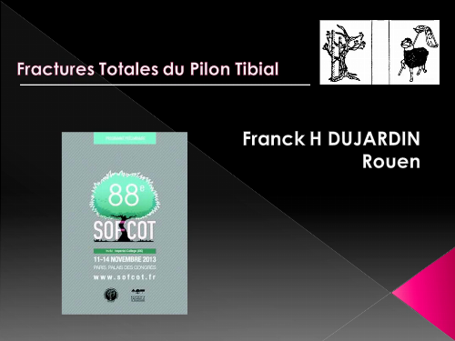 Fractures totales du pilon tibial