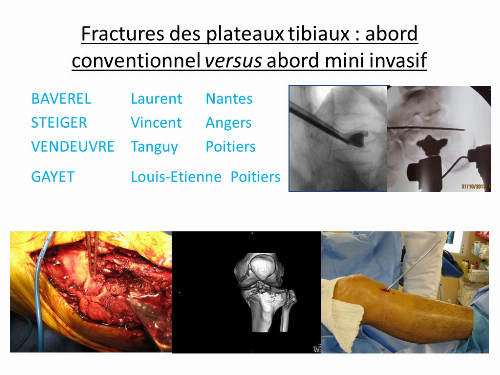 Table ronde : Fractures des plateaux tibiaux : abord conventionnel versus abord mini-invasif