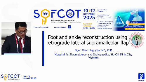 Table ronde VOA  : Foot and ankle reconstruction using retrograde lateral supramalleolar flap