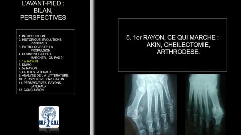 Table ronde : Chirurgie percutanée de l’avant-pied - 4