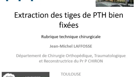 Extraction des tiges de PTH bien fixees - JM. LAFOSSE