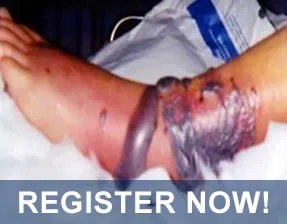 REGISTER NOW: EFORT Webinar ‘Pilon Fractures: Current Insights in their Management’ on 29 March 2021