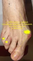 hallux valgus